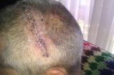 psychosurgery Fascinating History of Psychosurgery
